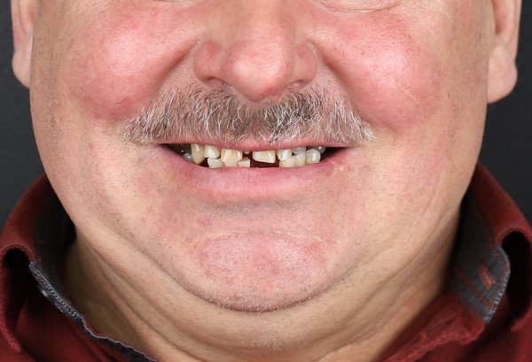 Brakuje mi zębów