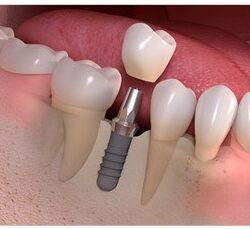 implant zęba Opole